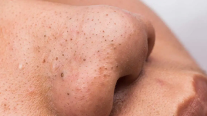 What is Causing Your Blackheads and What You Can Do to Treat Them