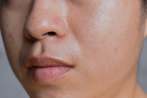 Facials Regime to Combat Oily Skin