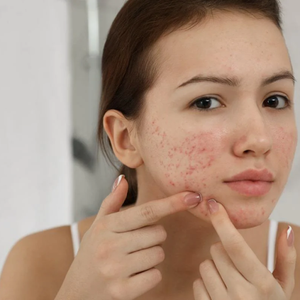 Reasons Skincare routine for the acne-prone isn’t working